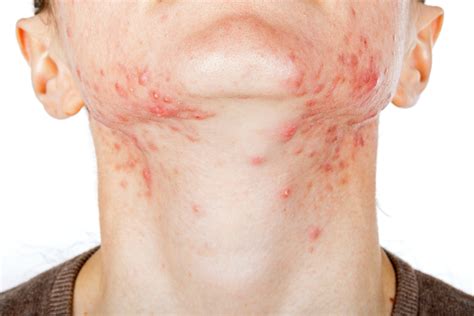 And the skin conditions are the most significant indicators of these changes. . Hormonal skin rash pictures